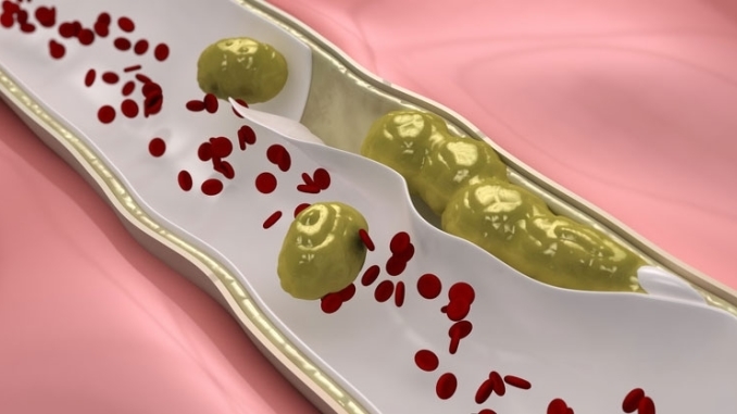 cholesterin-spiegel-senken cholesterin-spiegel-senken
