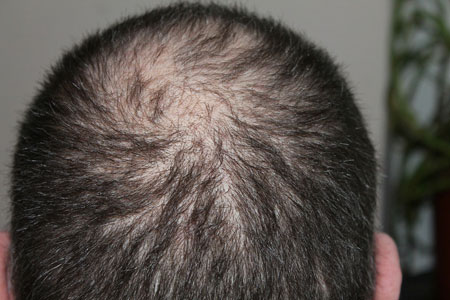 Haarausfall Haarwachstum fördern